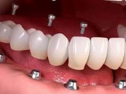 تصمیم سخت؛ فرق ایمپلنت یا دندان ثابت؟ متخصصان چه می گویند؟